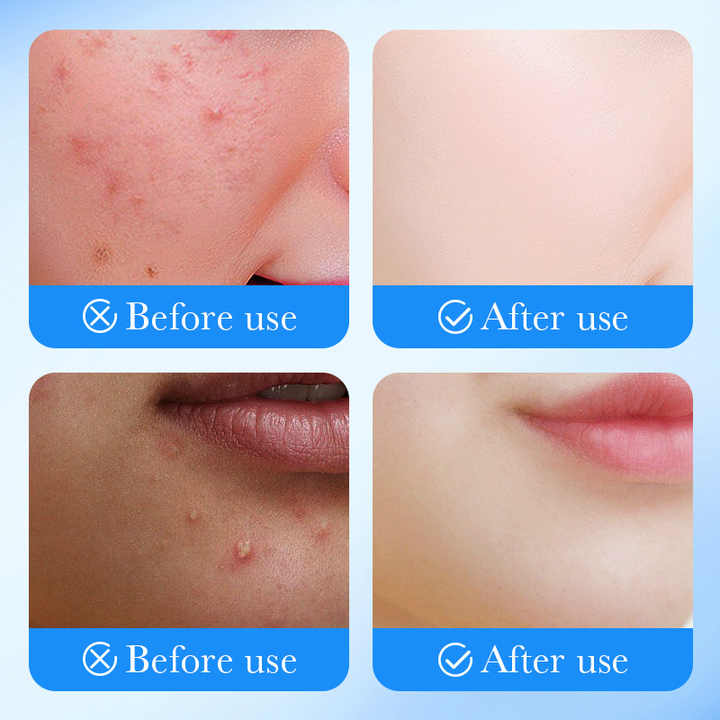 Acne patch